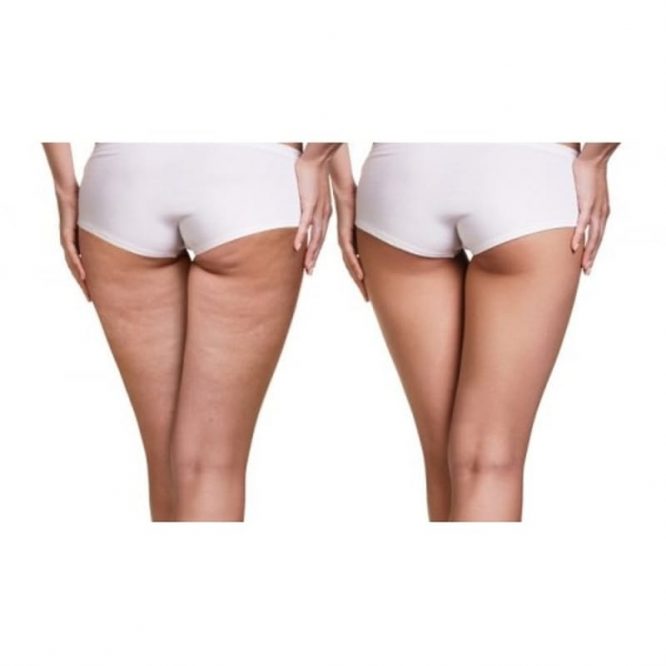 Maxtop 4-in-1 Anti Cellulite Infrared Massager - Image 2